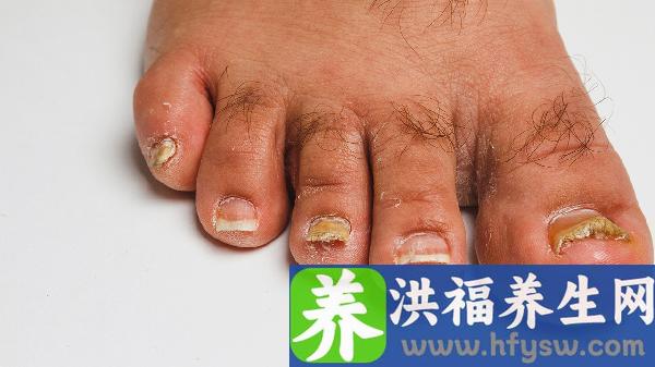 甲沟炎怎么治疗最快最好方法