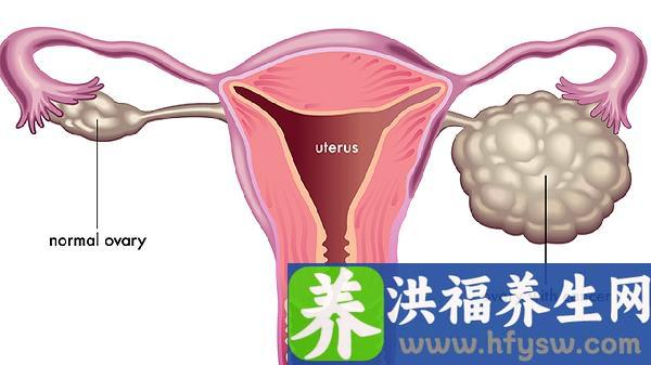 宫颈癌为什么会闭经和出血