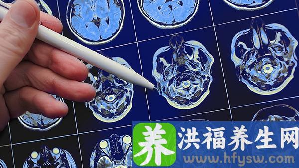 老年人摔脑出血恢复期多久
