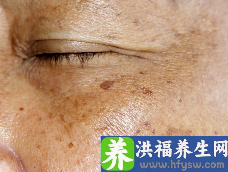带你了解去除眼角黄褐斑和眼角纹的方法