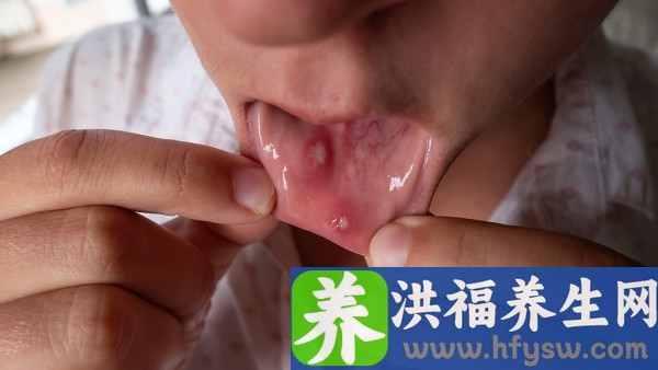胃上火口臭吃什么药 上火口臭吃小柴胡颗粒效果好吗