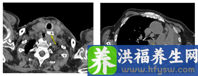 向春节坚守岗位的他们致敬！94岁老人被2厘米鸡骨惊险卡喉，七个专科大年初一“集结拆弹”