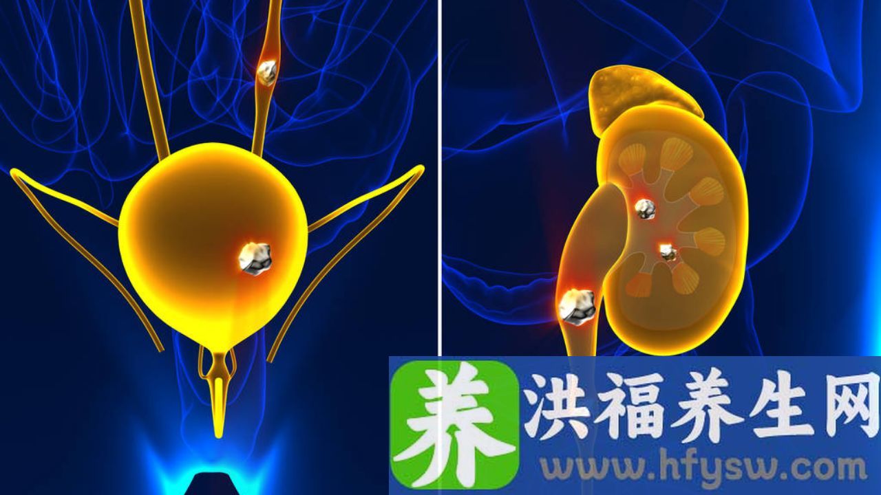 小便疼痛因为肾结石吗