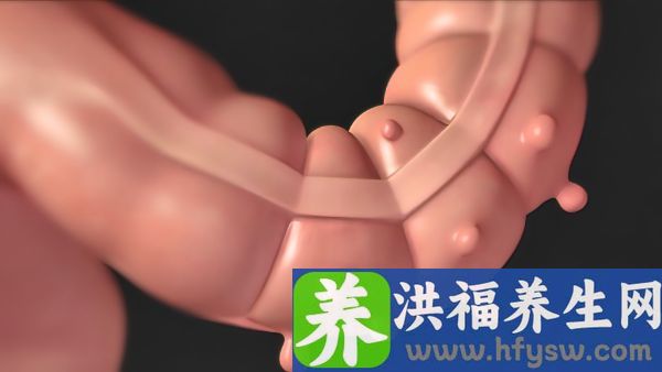 上消化道溃疡的病因