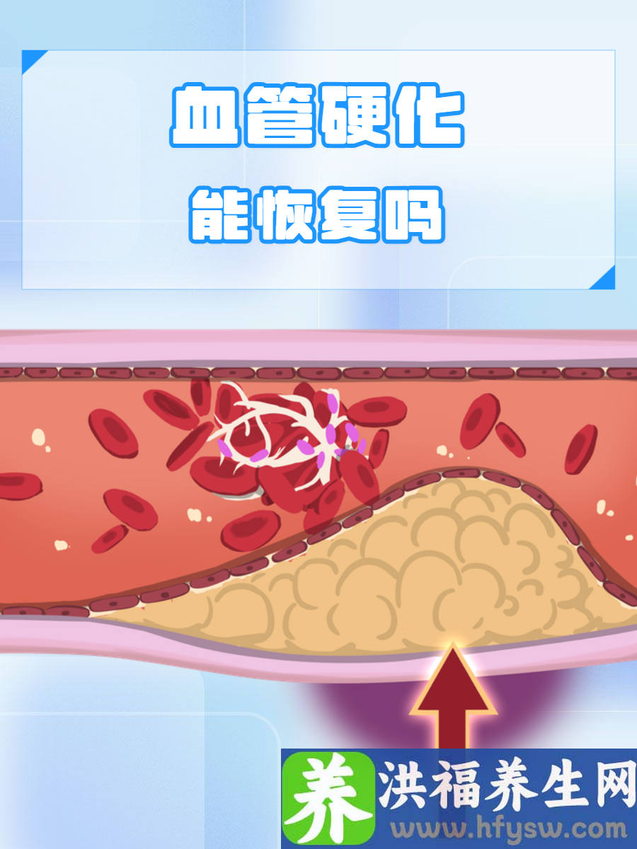 血管硬化能恢复吗？看完便可了解真相