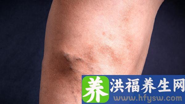 体重突然增加腿水肿是怎么回事