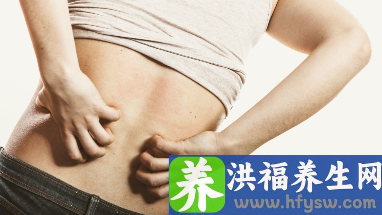 登革热皮疹会痒吗