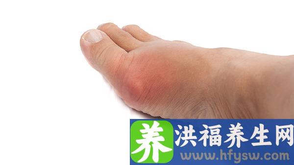 尿酸高的痛风石什么症状