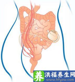 膀胱起搏器是什么？