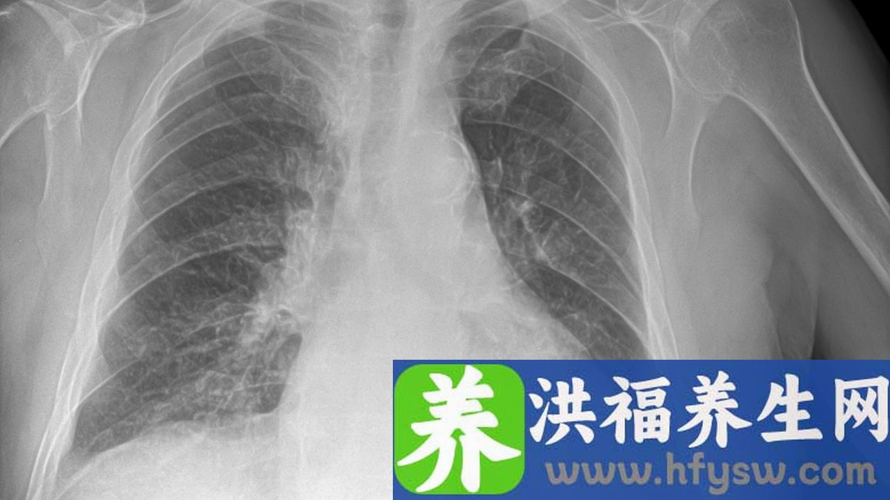 军团菌肺炎的症状