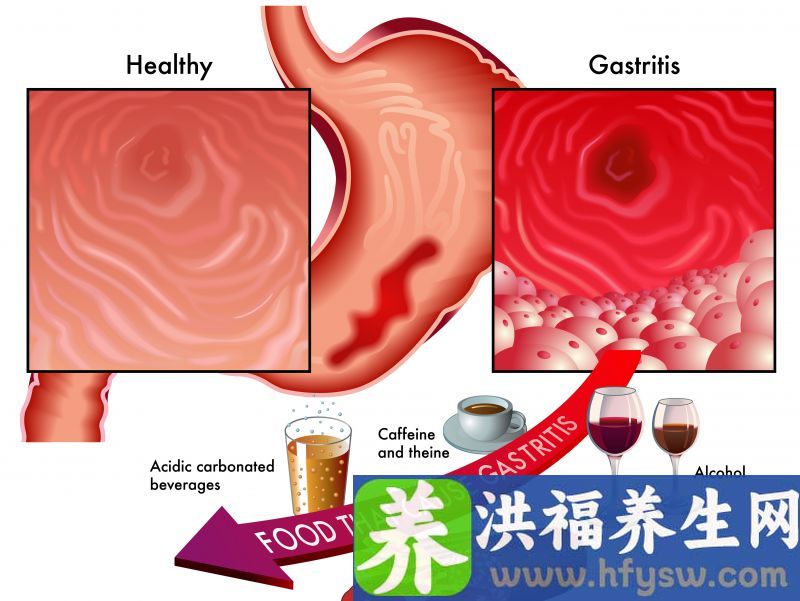 想要守护你的胃，提醒：3种食物别吃，这2个习惯要坚持
