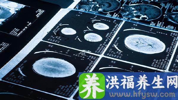人的记忆力减退是怎么回事