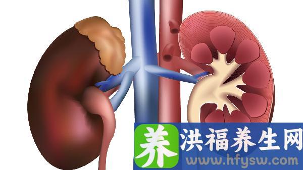 肾积水的人饮食需要注意什么