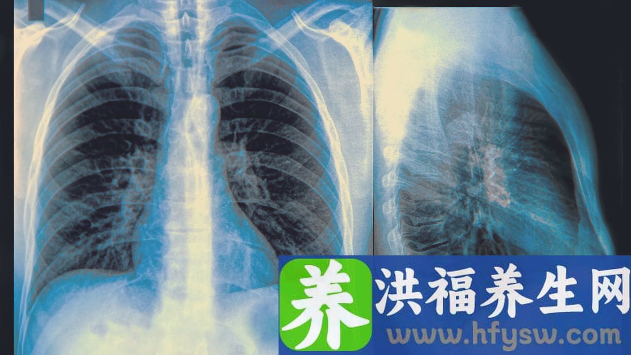 结核性脓胸的症状