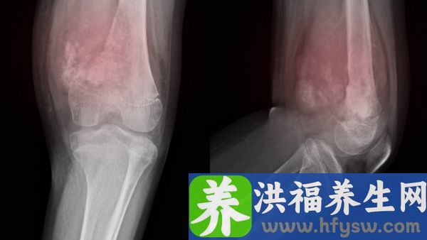 关节积液的原因是什么