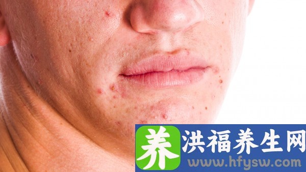 急性前列腺炎小腹胀疼