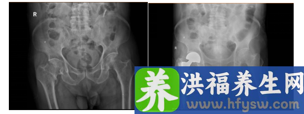 95岁老兵获新生：多学科协作助高龄老人跨越"人生最后一次骨折"