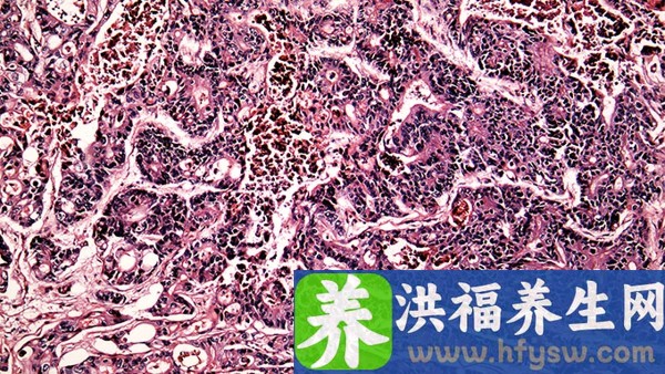 感染了艾滋病多久能查出来？哪些症状能判得了艾滋病