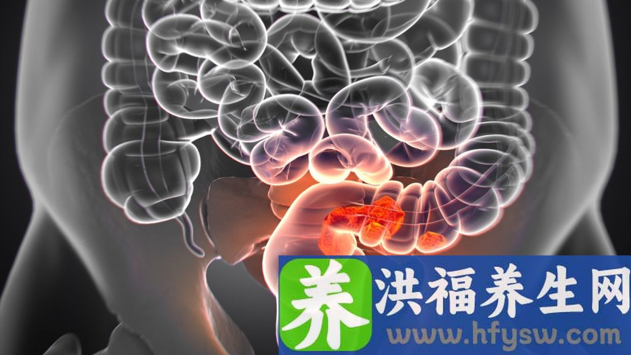溃疡性直肠炎怎么办