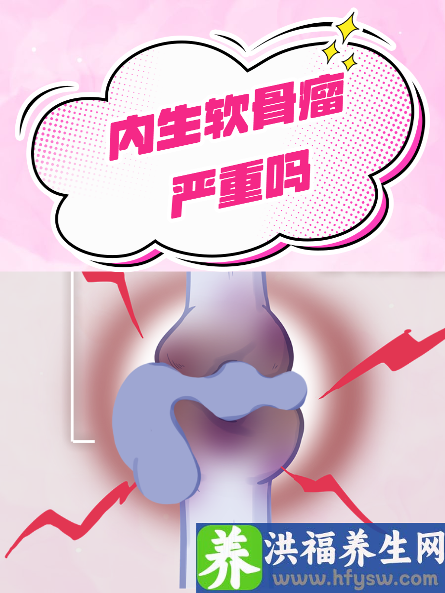 内生软骨瘤严重吗？一文告诉你答案