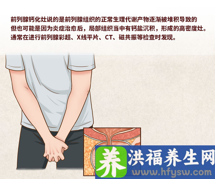 前列腺钙化灶是啥意思