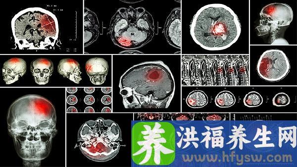 肾上腺肿瘤手术风险大不大呀