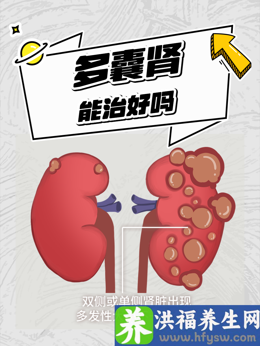 多囊肾能治好吗？教你读懂多囊肾的治疗效果