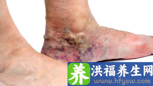 脚背缝针拆线后有肿怎么办