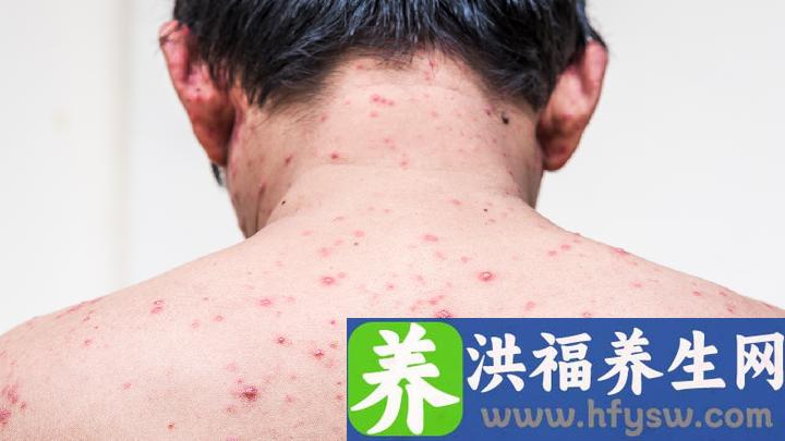 汗疱疹是身体内缺什么
