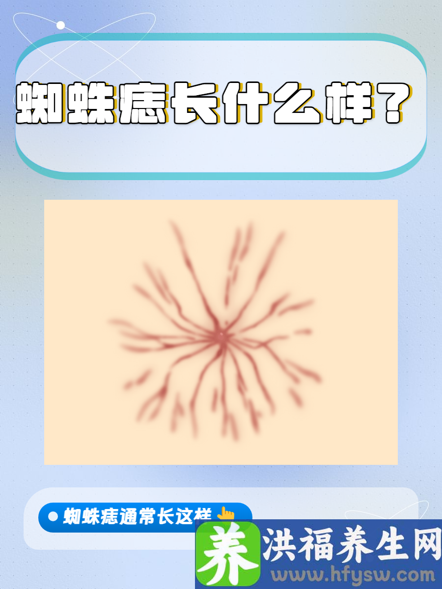 蜘蛛痣长什么样？蜘蛛痣识别与处理