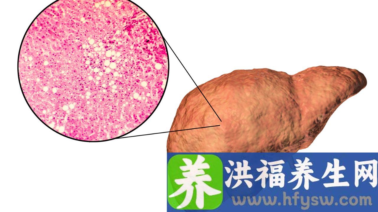重度脂肪肝是什么原因造成的