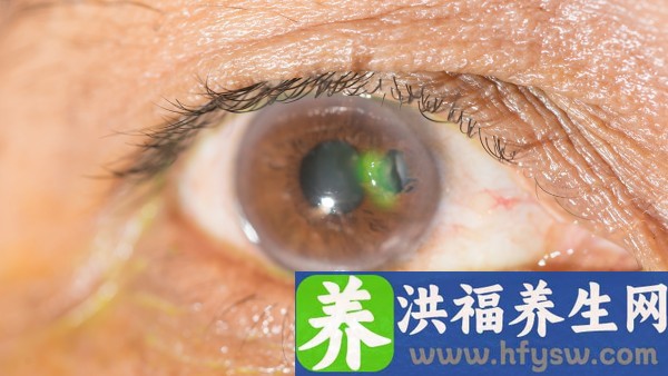 药物及中毒性白内障症状