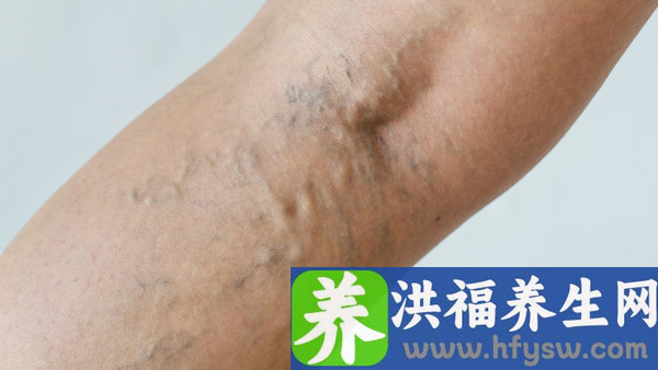 做完包皮手术后，水肿会自行消退吗？