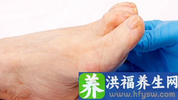 2型糖尿病可以吃粉条