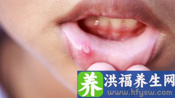 口腔溃疡频发或是免疫系统有问题 推荐两大疗法治疗口腔溃疡