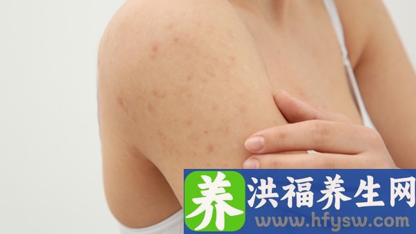 生殖器疱疹吃什么药好