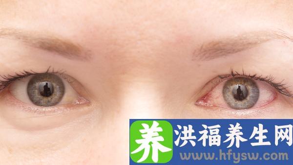 带隐形眼镜时眼睛干怎么办