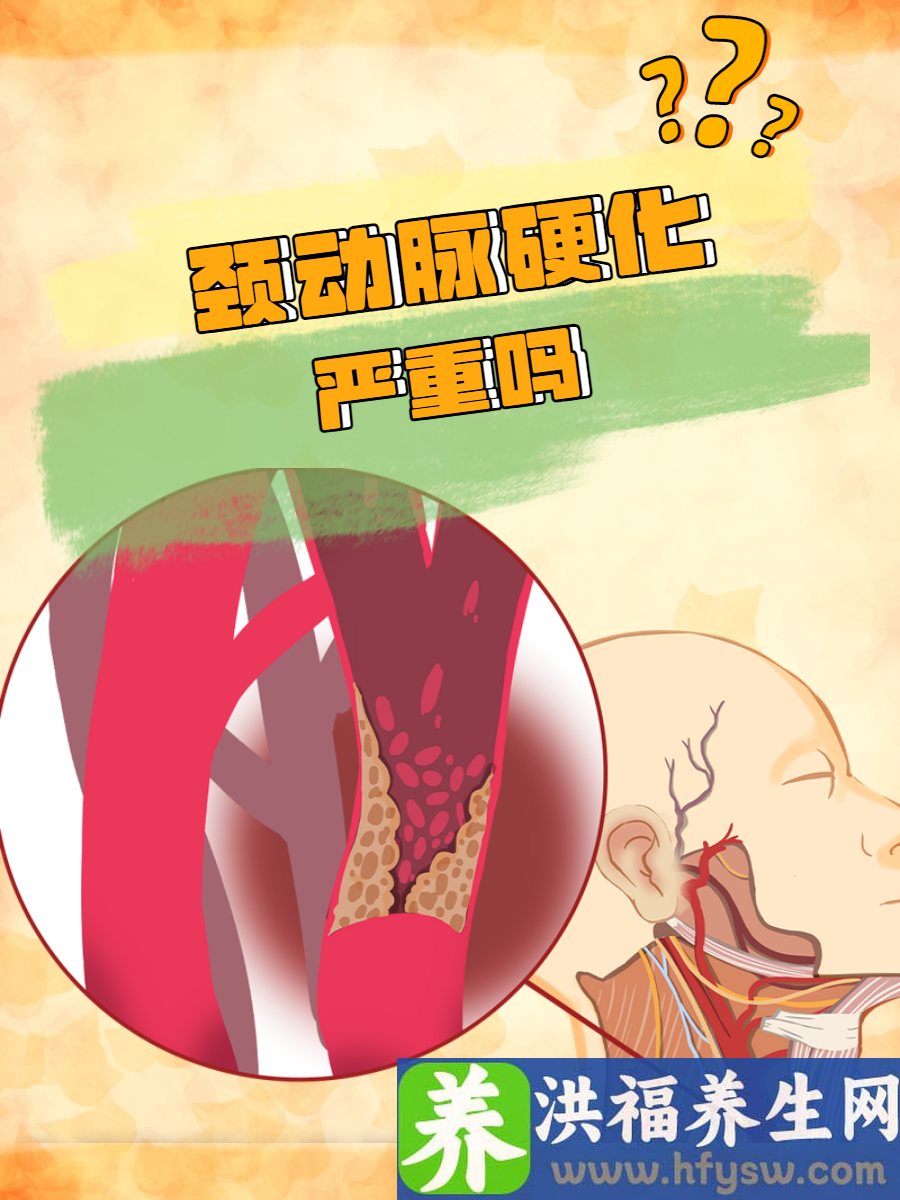 颈动脉硬化严重吗？了解严重性很重要