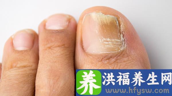 一岁宝宝甲沟炎红肿怎么治