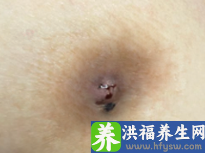 58岁女性患乳腺导管内乳头状瘤，术后恢复良好