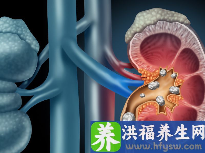 肾结石饮食注意事项