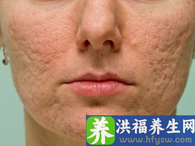 痘印是瘢痕 可用点阵激光去除
