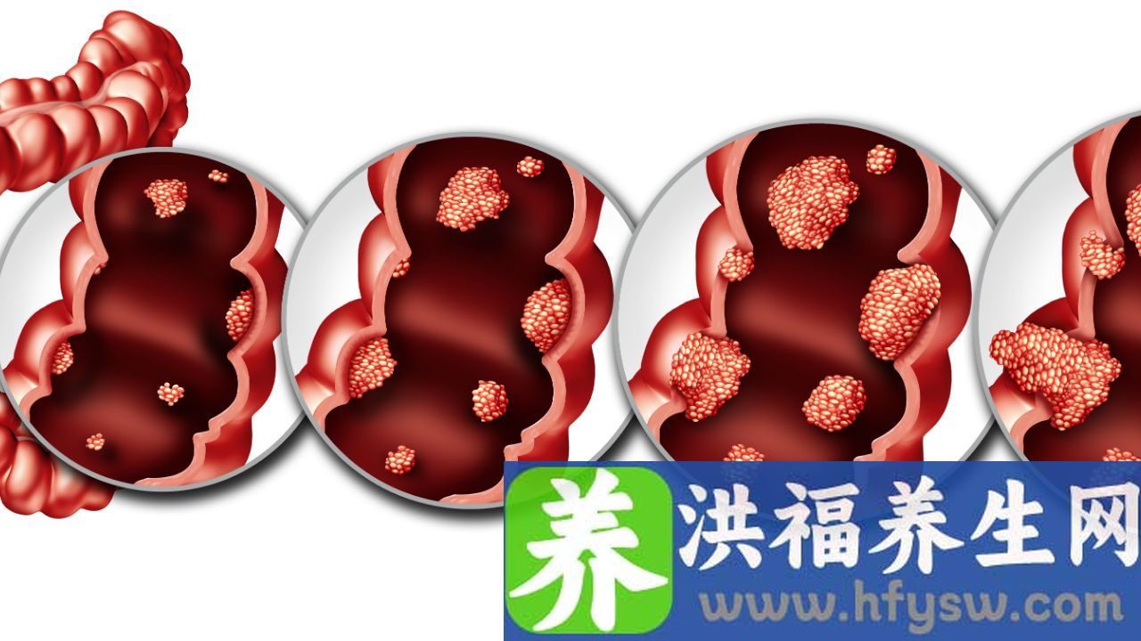 直肠炎一定会癌变吗
