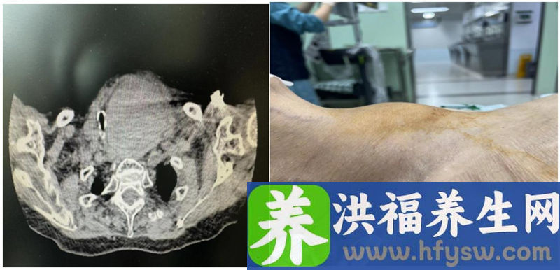 突发颈部肿大竟是甲状腺肿物出血，多学科医生紧急集合为96岁婆婆“拆弹”