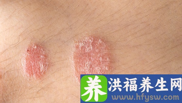 治疗银屑病的口服药有哪些 银屑灵颗粒是抗病毒的药吗