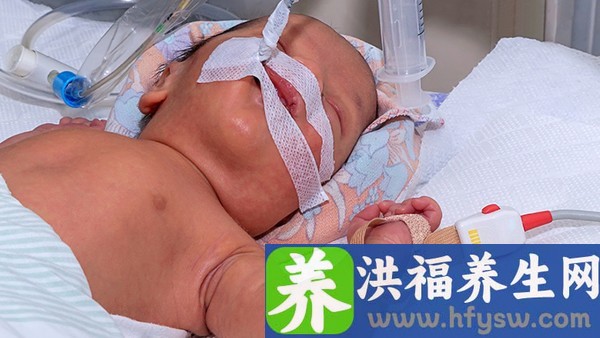 婴儿母乳性腹泻如何治疗