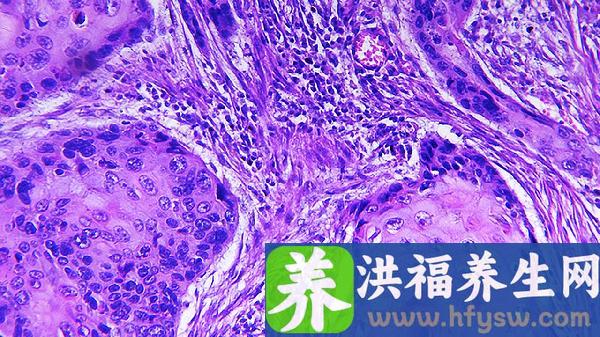 腰突压迫神经导致腿疼怎么治疗