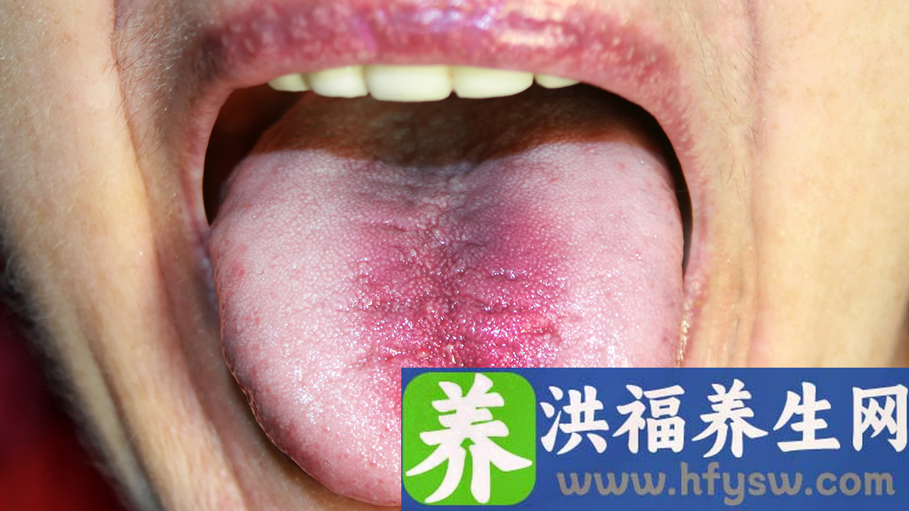 生殖器疱疹常见这些症状表现 生殖器疱疹的症状会有哪些