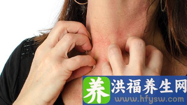 突发性红斑狼疮是什么样的