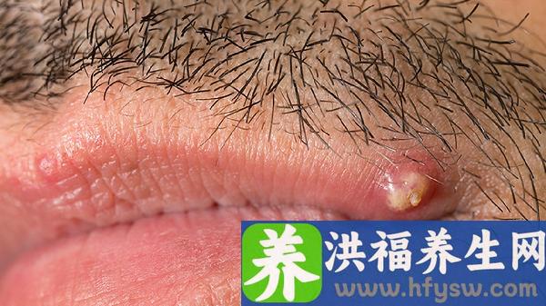 男性生殖器疱疹疼吗